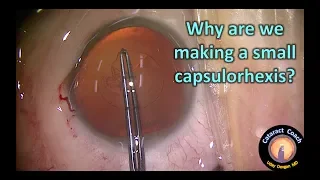 Why are we making a small capsulorhexis in this Cataract Surgery?