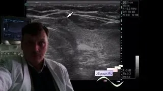 Thyroid ultrasound - Hypoechoic node in the isthmus