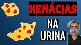 Hemácias na urina: Problemas de saúde que causam essa alteração