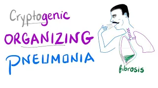 Cryptogenic Organizing Pneumonia | Lung fibrosis | Restrictive Lung Disease | Pulmonology
