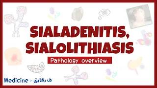 Sialadenitis & Sialolithiasis - salivary gland diseases, pathology overview, head & neck surgery شرح