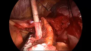 Asvide: Ablation of left pulmonary veins, ligament of Marshall, ganglionated plexi, and left...