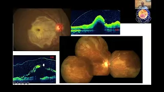 UVEITIS GRAND ROUNDS 5