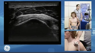 Sonographic assessment of the supraspinatus and infraspinatus tendons for POCUS clinicians