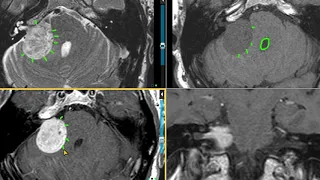 MRI Mastery Series -- CP Angle Masses (Trailer)