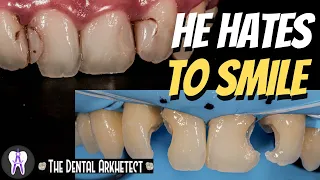 Amazing Restoration of Patient's Smile and Confidence #c31 #4k