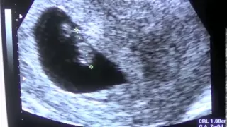 Pregnancy Vlog Week 7 First Ultrasound