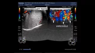 Ultrasound Video showing varicocele.