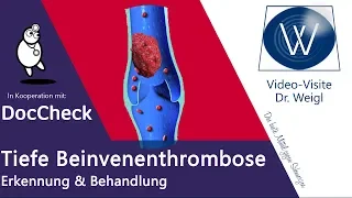 Tiefe Beinvenenthrombose (TVT): Die Gefahr des Übersehens - Thrombose oder Muskelzerrung DocCheck #3