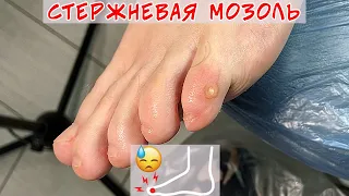 Removal of callus on the little toe