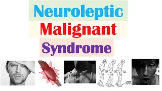 Neuroleptic Malignant Syndrome | Causes, Pathophysiology, Symptoms, Diagnosis, Treatment