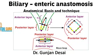 Roux-en-Y hepaticojejunostomy - anatomical basis and steps of surgery - Biliary-enteric anastomosis