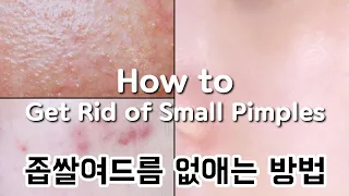 Revealing how to get rid of small pimples overnight!! How to Get Rid of Small Pimples