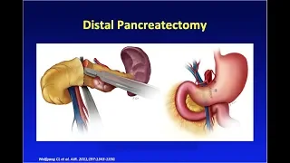 MDCT of Pancreatic Surgery: Normal Post-Op vs. Complications Part 1