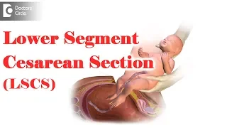 What is LSCS delivery? Are you awake during an emergency C section? - Dr. Mini Salunkhe of C9