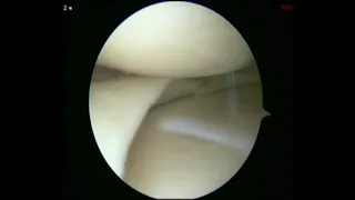 Technique for All-Inside Repair of Bucket-Handle Meniscus Tears