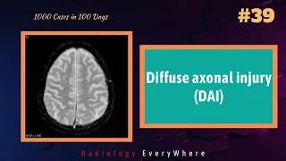 Diffuse Axonal Injury Radiology tutorials 1000 videos in 100 days video 39