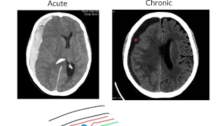 Subdural haemorrhage