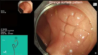 UNDERWATER POLYPECTOMY OF LARGE FLAT LST AT SPLENIC FLEXURE