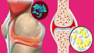 Septic (Infectious) Arthritis: Causes And Treatment