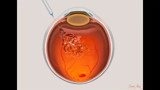 Anti-VEGF intravitreal injection