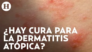 Dermatitis atópica: Qué la causa, cuáles son los síntomas y qué tratamientos hay | Médico H