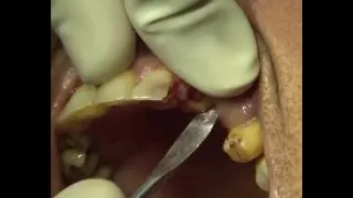 Broken upper front tooth removal