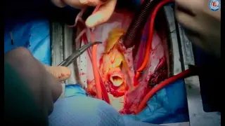 Total aortic arch replacement with frozen elephant trunk (Thoraflex)