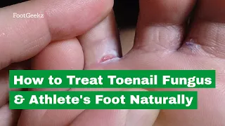 How to Treat Toenail Fungus & Athlete's Foot Naturally
