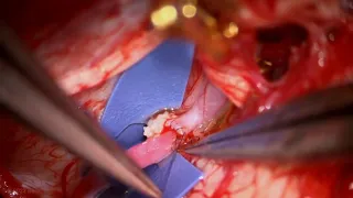 Dolichoectatic PICA Aneurysm: Excision and PICA Double Reimplantation Bypass