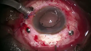 Large Intra Ocular Foreign Body