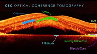 Central Serous Chorioretinopathy Part 2