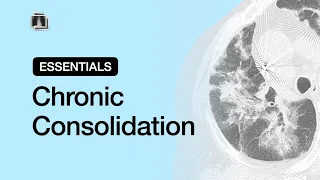 Chronic Consolidation | Chest Radiology Essentials