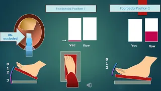 Basics of Phaco -  Part I (for Part II https://www.youtube.com/watch?v=UY6ZdPKPaJ4)  quickguide.org