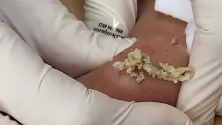 Huge Pimple gets sliced open (don't look away!)