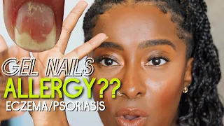 Allergic To Gel Nails? Eczema/Psoriasis of the Nails