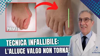 Alluce valgo: 3 MESI DOPO l' intervento | Tecnica Dott. Andrea Scala GARANZIA: NO ALLUCE RECIDIVO!