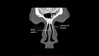 Coronal CT section of nose and paranasal sinuses