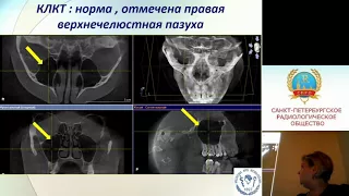 Зубарева АА. "КЛКТ в дифференциальной диагностике синуситов"