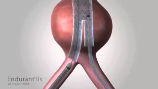 Endurant IIs Aortic Graft