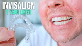 10 Things I Wish I Knew BEFORE Getting Invisalign