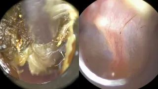 134 - Extreme Ear Wax Blockage Removal From Tender Ear using WAXscope®️