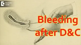 How many days do you bleed after a D&C? - Dr. Sagar Bumb