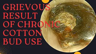 GRIEVOUS Result Of Chronic Cotton Bud Use (Very Satisfying Earwax Removal)
