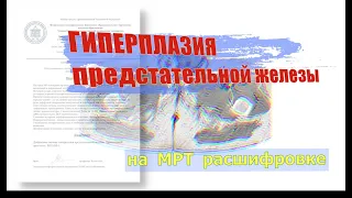 ГИПЕРПЛАЗИЯ предстательной железы на РАСШИФРОВКЕ МРТ малого таза. Хронический ПРОСТАТИТ у мужчин.