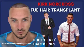 TOWIE star Kirk Norcross gets hair transplant at British Hair Clinic