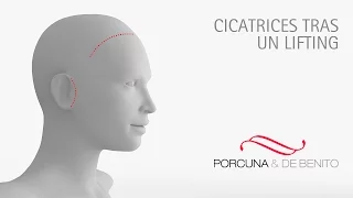 Cicatrices tras un lifting