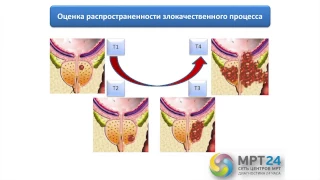 МРТ мужcкого малого таза