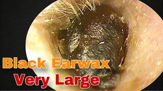 BIGGEST Earwax, Difficult Removal, EP 12 | Doctor Anh