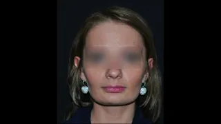 Как изменить квадратное лицо. Коррекция контура овала лица с помощью пластической операции.